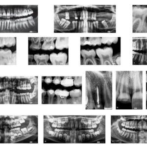Dental X-Rays